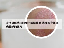 冶疗银屑病沈阳哪个医院最好 沈阳治疗银屑病最好的医院