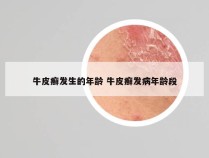牛皮癣发生的年龄 牛皮癣发病年龄段