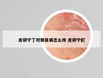 皮研宁丁对银屑病怎么样 皮研宁酊