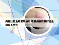 胸腺肽能治疗银屑病吗 银屑病胸腺肽好还是胸腺五肽好