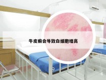 牛皮癣会导致白细胞增高