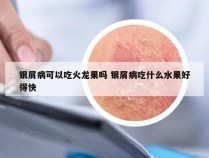 银屑病可以吃火龙果吗 银屑病吃什么水果好得快