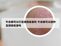 牛皮癣可以打宫颈癌疫苗吗 牛皮癣可以接种宫颈癌疫苗吗