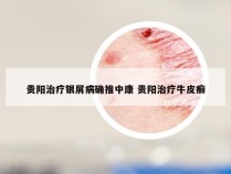 贵阳治疗银屑病确推中康 贵阳治疗牛皮癣