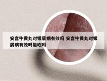 安宫牛黄丸对银屑病有效吗 安宫牛黄丸对银屑病有效吗能吃吗