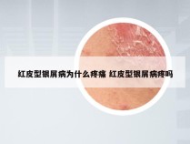 红皮型银屑病为什么疼痛 红皮型银屑病疼吗