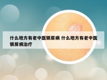什么地方有老中医银屑病 什么地方有老中医银屑病治疗