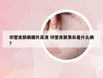 印堂皮肤癣图片高清 印堂皮肤发白是什么病?