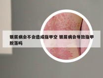 银屑病会不会造成指甲空 银屑病会导致指甲脱落吗