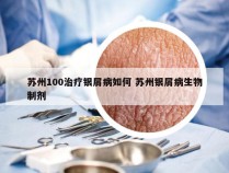 苏州100治疗银屑病如何 苏州银屑病生物制剂