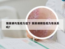 银屑病与免疫力低下 银屑病跟免疫力有关系吗?