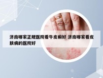 济南哪家正规医院看牛皮癣好 济南哪家看皮肤病的医院好