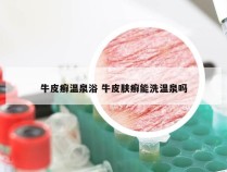 牛皮癣温泉浴 牛皮肤癣能洗温泉吗