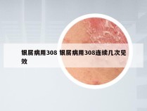 银屑病用308 银屑病用308连续几次见效