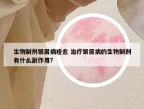 生物制剂银屑病痊愈 治疗银屑病的生物制剂有什么副作用?