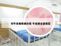 对牛皮癣疾病分类 牛皮癣全部类型