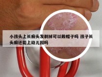 小孩头上长癣头发剃掉可以戴帽子吗 孩子长头癣还能上幼儿园吗