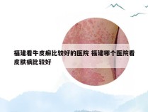 福建看牛皮癣比较好的医院 福建哪个医院看皮肤病比较好