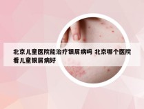 北京儿童医院能治疗银屑病吗 北京哪个医院看儿童银屑病好