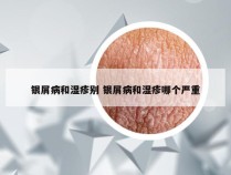 银屑病和湿疹别 银屑病和湿疹哪个严重