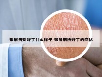 银屑病要好了什么样子 银屑病快好了的症状