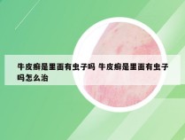 牛皮癣是里面有虫子吗 牛皮癣是里面有虫子吗怎么治