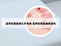 遗传性银屑病几岁发病 遗传性银屑病传染吗