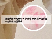 银屑病刚开始只有一个点吗 银屑病一边消退一边长新的正常吗