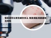 银屑病可以用生酮饮食么 银屑病能用酮康唑洗剂吗