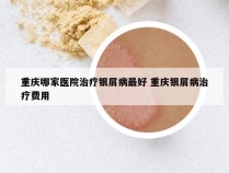 重庆哪家医院治疗银屑病最好 重庆银屑病治疗费用