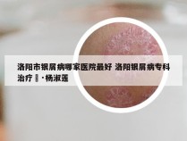 洛阳市银屑病哪家医院最好 洛阳银屑病专科治疗冚·杨淑莲