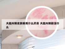 大腿内侧皮肤癣用什么药膏 大腿内侧藓涂什么