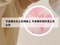 牛皮癣从头上长到身上 牛皮癣长到头发上怎么办