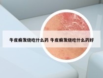 牛皮癣发烧吃什么药 牛皮癣发烧吃什么药好