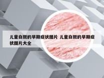 儿童白斑的早期症状图片 儿童白斑的早期症状图片大全