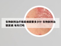 生物制剂治疗银屑病需要多少针 生物制剂治银屑病 每年打吗