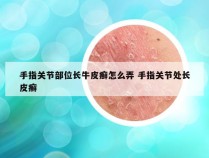 手指关节部位长牛皮癣怎么弄 手指关节处长皮癣