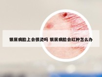 银屑病脸上会很烫吗 银屑病脸会红肿怎么办