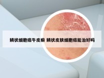鳞状细胞癌牛皮癣 鳞状皮肤细胞癌能治好吗