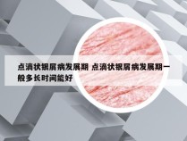 点滴状银屑病发展期 点滴状银屑病发展期一般多长时间能好