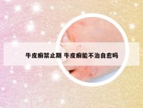 牛皮癣禁止期 牛皮癣能不治自愈吗