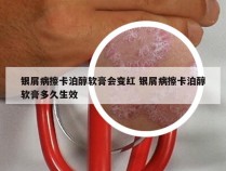 银屑病擦卡泊醇软膏会变红 银屑病擦卡泊醇软膏多久生效