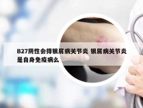 B27阴性会得银屑病关节炎 银屑病关节炎是自身免疫病么