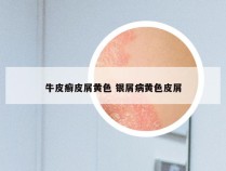 牛皮癣皮屑黄色 银屑病黄色皮屑