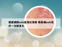 银屑病照uvb后发红发痒 银屑病uvb光疗一次照多久