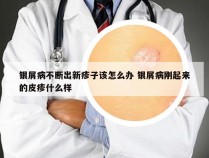 银屑病不断出新疹子该怎么办 银屑病刚起来的皮疹什么样