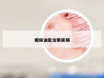 蟾蜍油能治银屑病