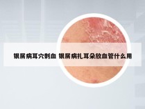 银屑病耳穴刺血 银屑病扎耳朵放血管什么用