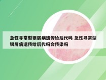 急性寻常型银屑病遗传给后代吗 急性寻常型银屑病遗传给后代吗会传染吗