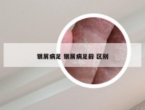 银屑病足 银屑病足藓 区别